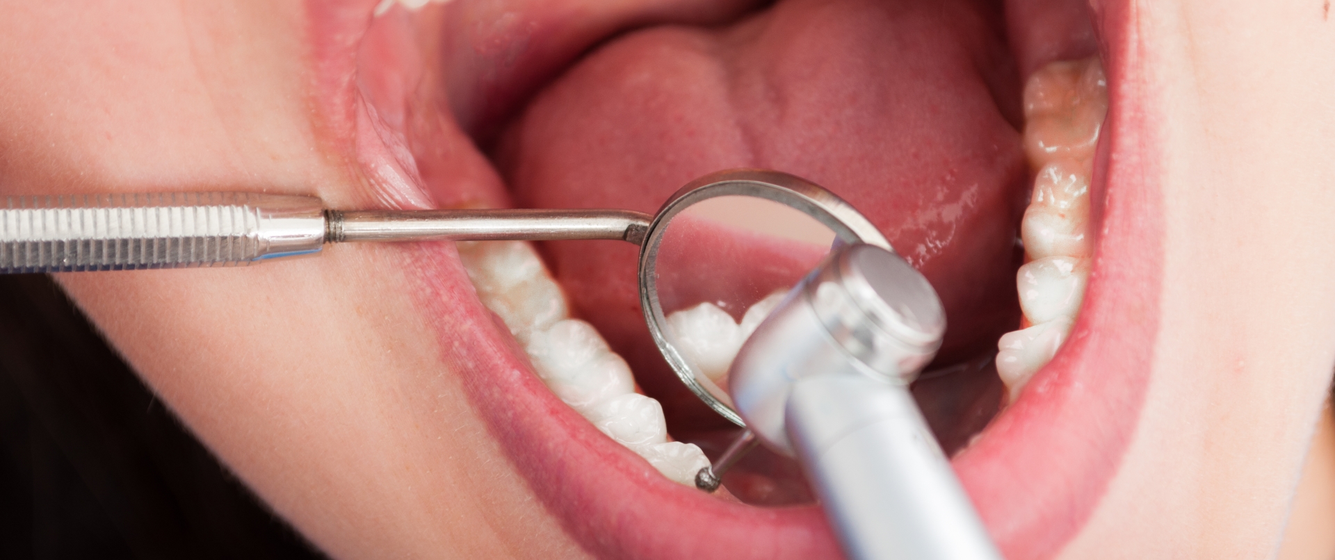 Endodoncia o Tratamiento de Conducto