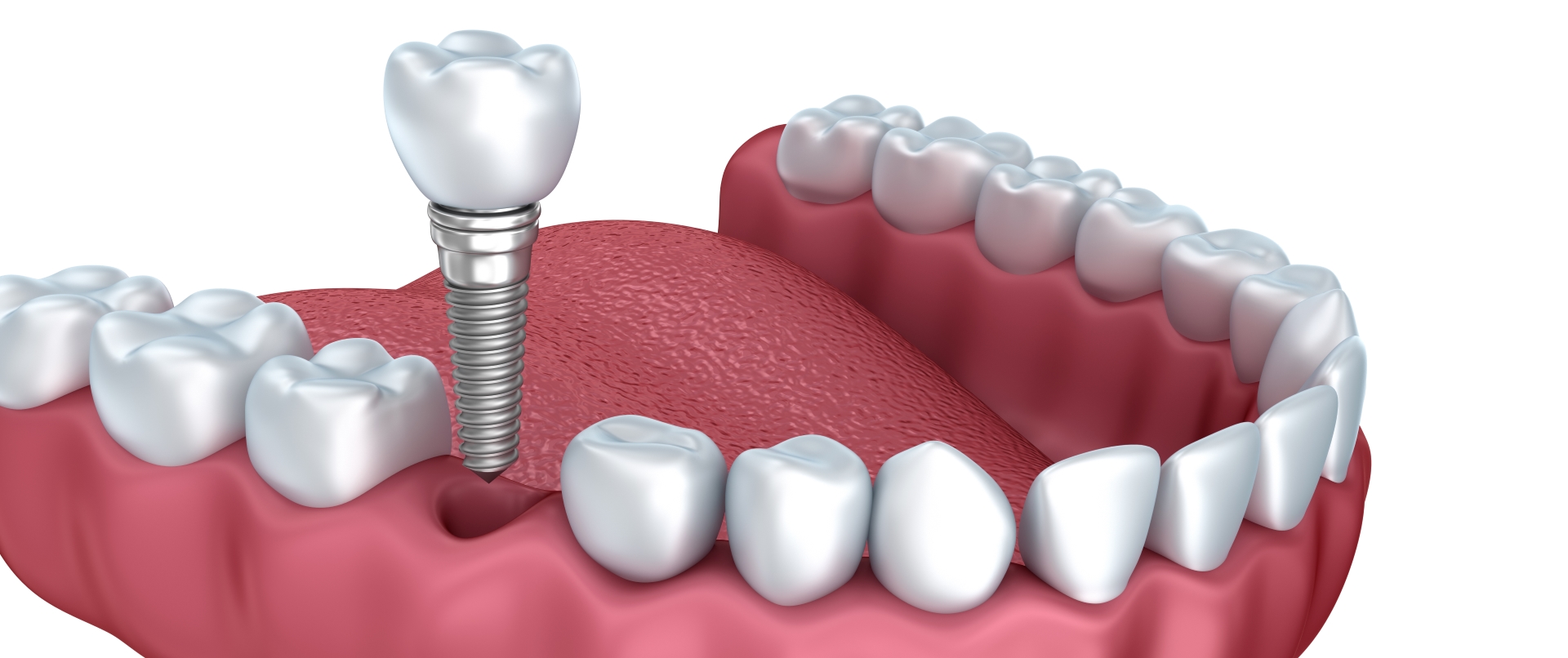 Implantes dentales