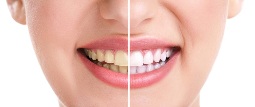 Blaqueamiento dental - Clínica Morena Dentistas